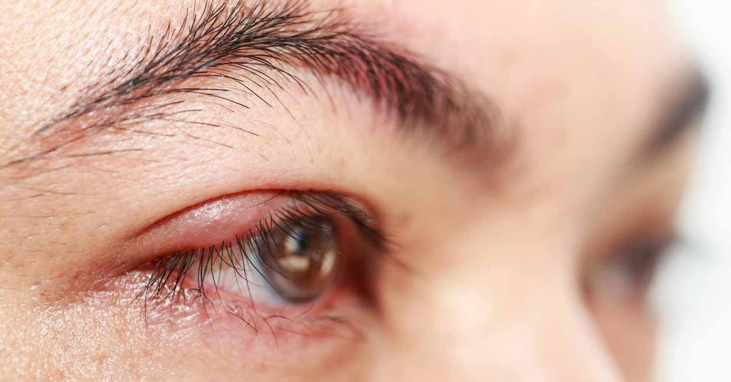 Mata Bintitan Obatnya Apa