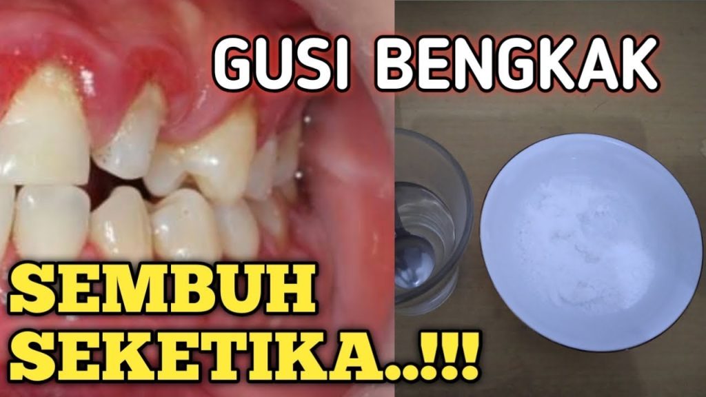 Gusi Bengkak Apa Obatnya
