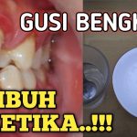Gusi Bengkak Apa Obatnya Gusi Bengkak Apa Obatnya