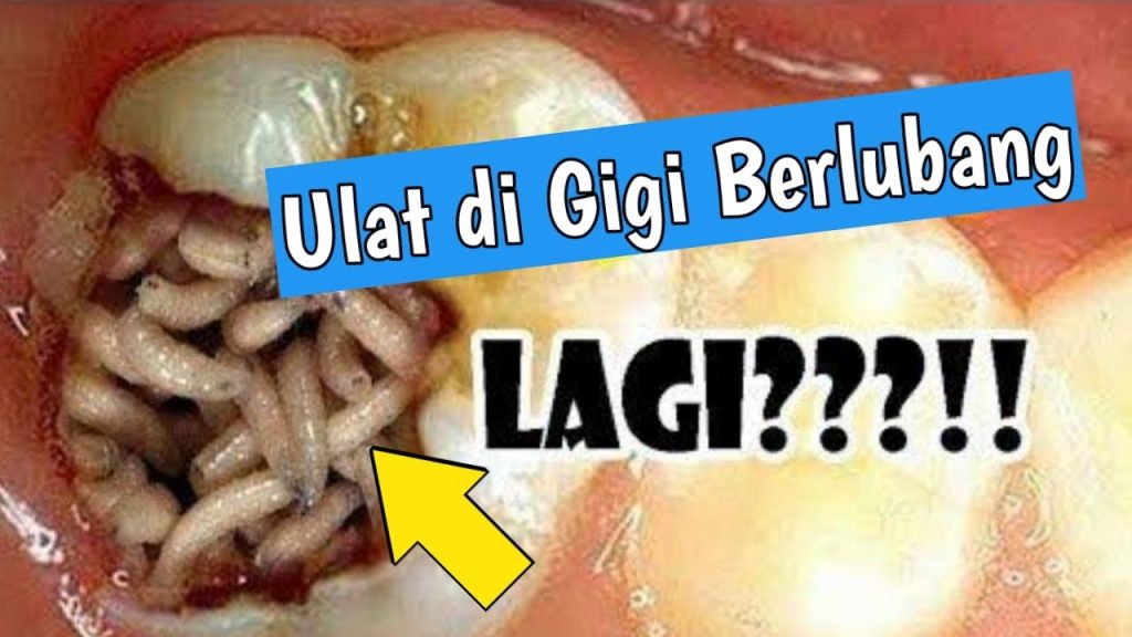 Apa Obat Sakit Gigi Berlubang Apa Obat Sakit Gigi Berlubang