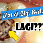 Apa Obat Sakit Gigi Berlubang