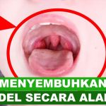 Cara Mengobati Amandel Dengan Air Garam