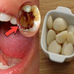 Cara Mengatasi Gigi Berlubang Yang Sakit Cara Mengatasi Gigi Berlubang Yang Sakit