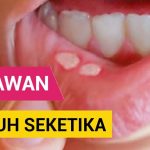 Obat Alami Sariawan Di Pinggir Bibir