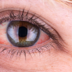 Mengobati Mata Merah