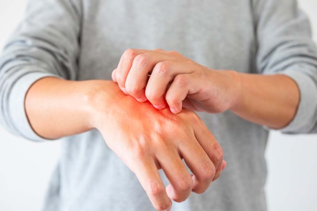 Gejala Alergi Obat Gejala Alergi Obat