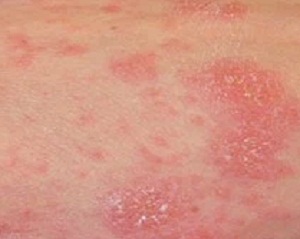 Obat Gatal Di Apotik Kimia Farma