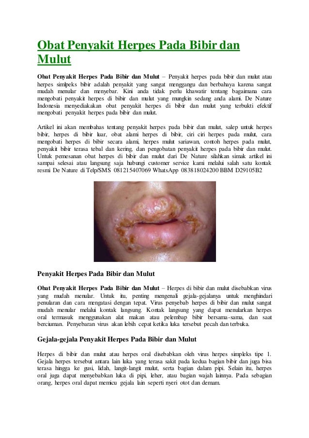 Obat Herpes Di Bibir Obat Herpes Di Bibir