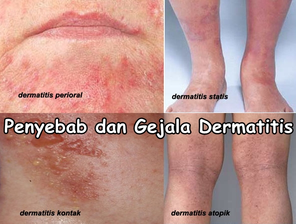 Obat Alami Alergi Gatal