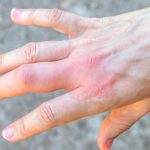 Cara Mengobati Tangan Bengkak