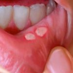 Sariawan Di Lidah Apa Obatnya