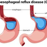 Gerd Adalah Penyakit