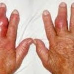 Mengobati Asam Urat Di Tangan