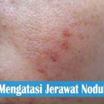 Mengobati Jerawat Mengobati Jerawat