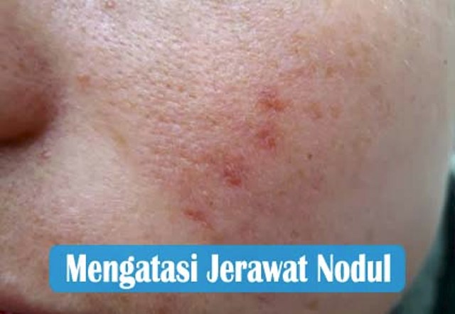 Mengobati Jerawat