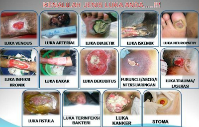 Obat Luka Robek Biar Cepat Kering Obat Luka Robek Biar Cepat Kering