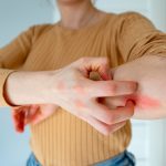 Mengatasi Alergi Obat